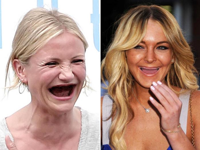 20 celebridades sem dentes 19