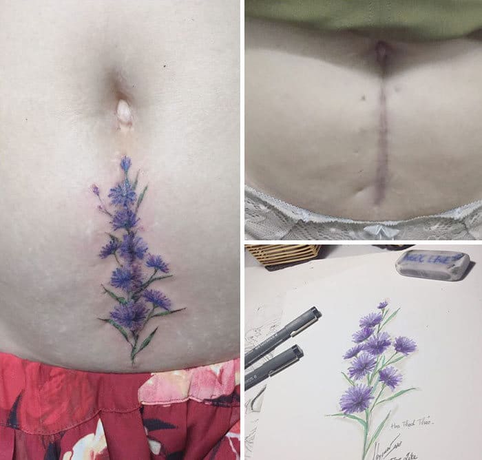 30 pessoas que pediram para encobrir suas cicatrizes com tatuagem 15