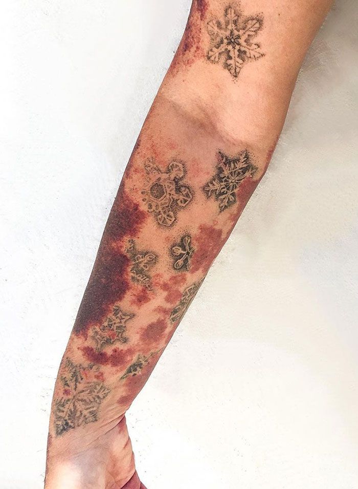 46 tatuagens incríveis que transformaram cicatrizes e marcas de nascença em obras de arte 44