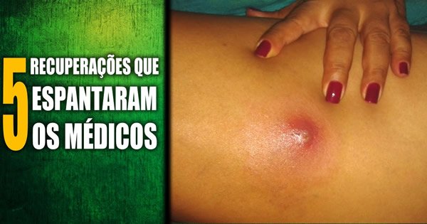 5 Recuperações que espantaram os médicos