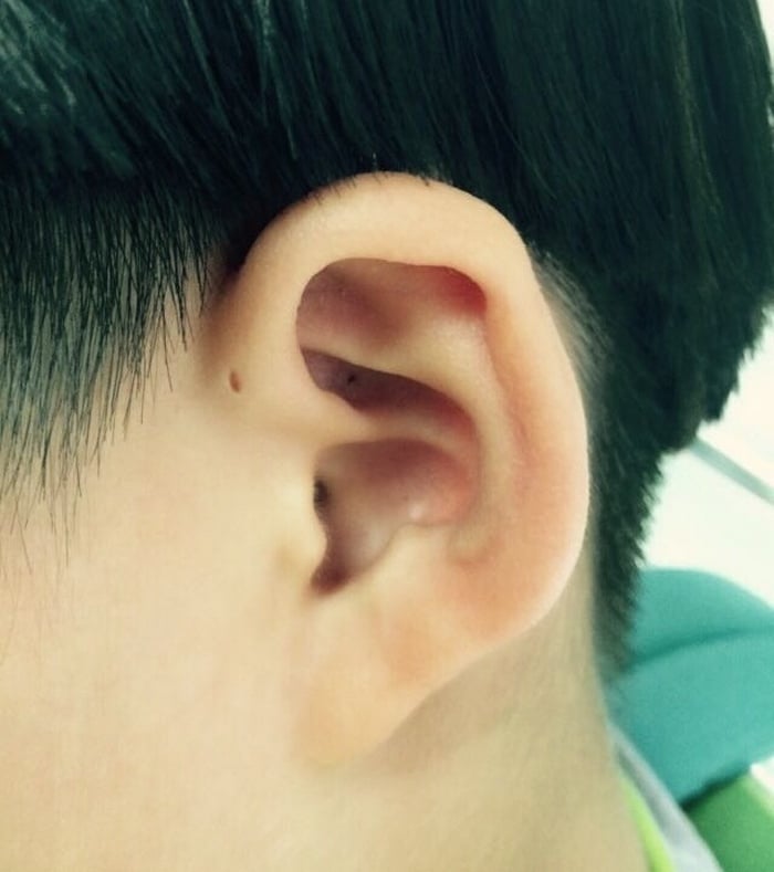 Algumas pessoas nascem com pequenos buracos ao lado de seus ouvidos