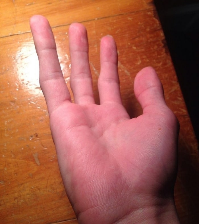 Sem dedo mindinho