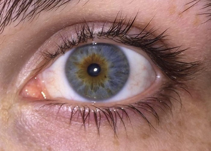 Descobri que tenho a mutação da distiquíase, o que significa que tenho várias fileiras de cílios