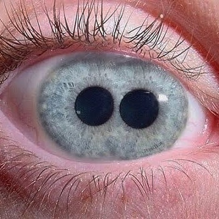 A condição em que um olho tem mais de uma pupila é chamada policoria