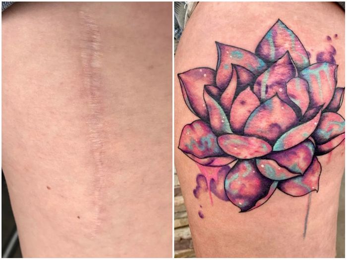 16 pessoas que usaram a arte das tatuagens para cobrir suas cicatrizes 3