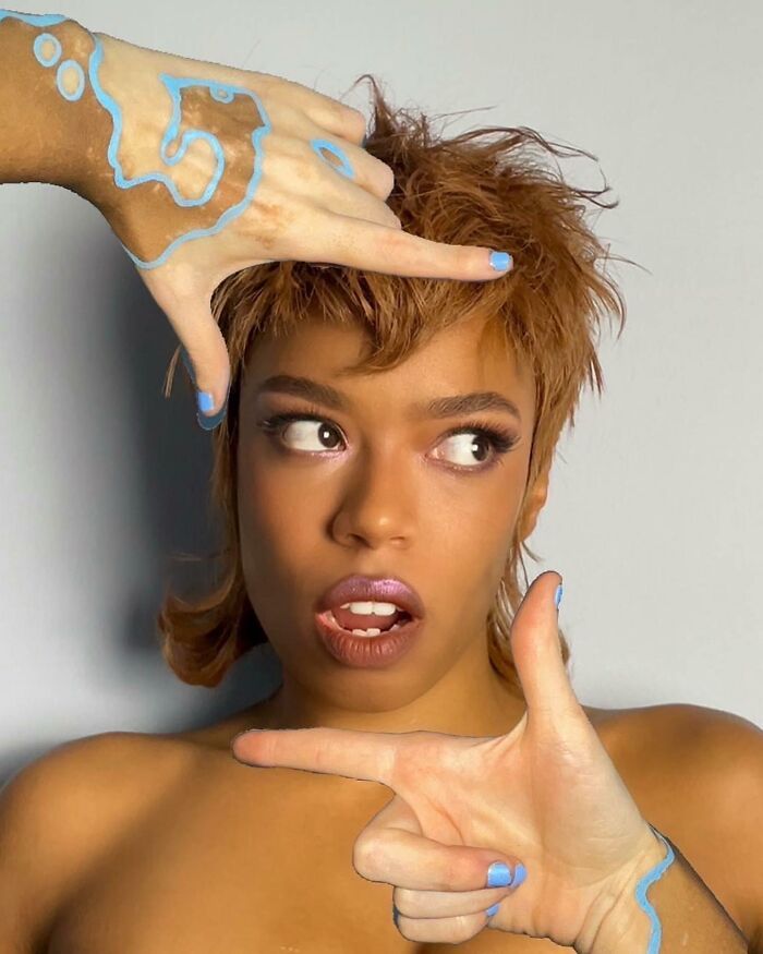 Amara Aleman: Transformando o vitiligo em arte e inspiração (20 fotos) 4