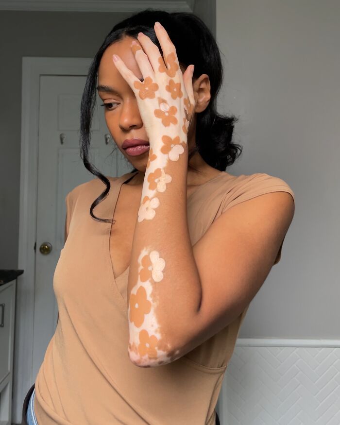 Amara Aleman: Transformando o vitiligo em arte e inspiração (20 fotos) 10