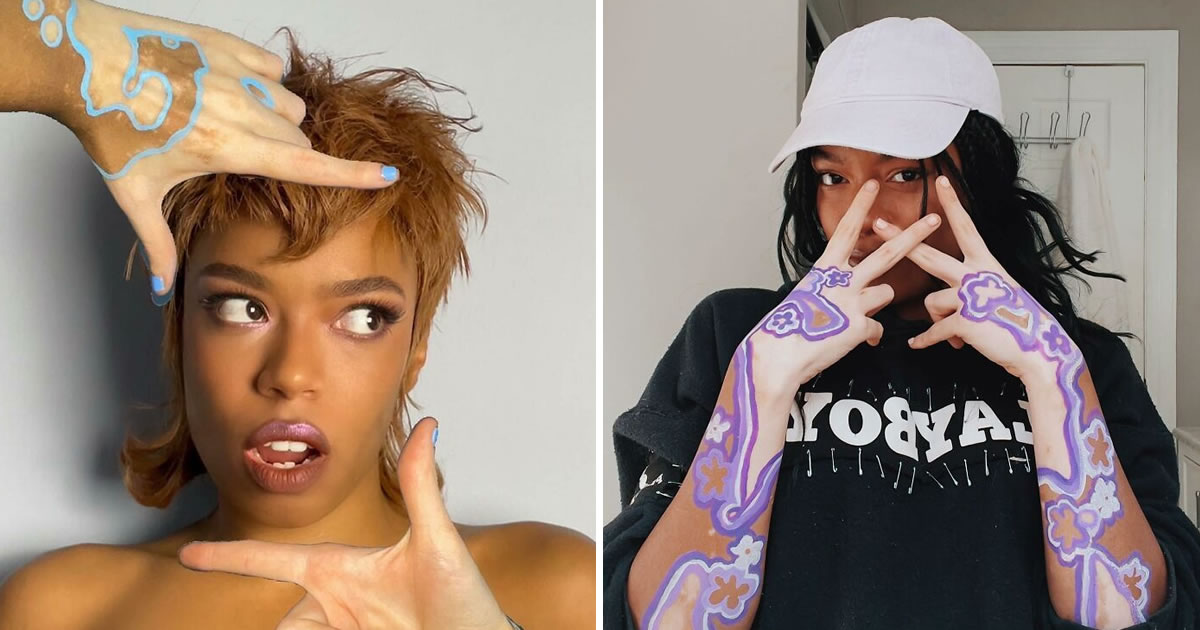Amara Aleman: Transformando o vitiligo em arte e inspiração (20 fotos)