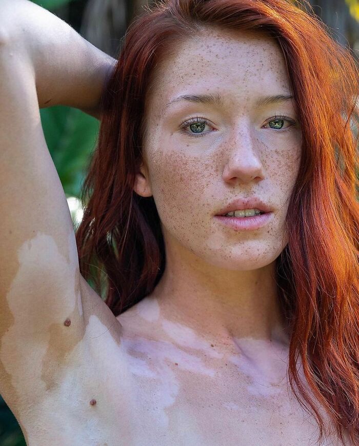 Vitiligo e autoestima: Perfil no Instagram transforma manchas em símbolo de beleza e identidade (30 fotos) 1 Vitiligo e autoestima: Perfil no Instagram transforma manchas em símbolo de beleza e identidade (30 fotos) 1