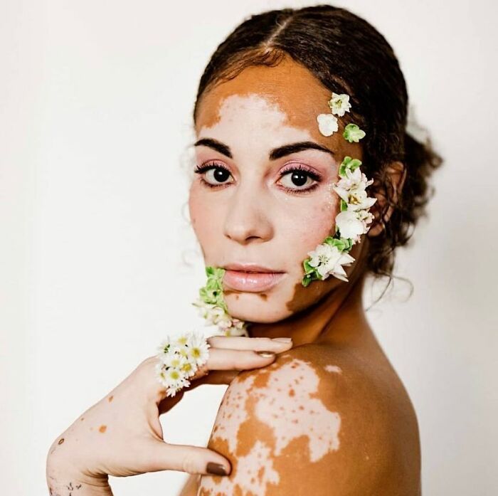 Vitiligo e autoestima: Perfil no Instagram transforma manchas em símbolo de beleza e identidade (30 fotos) 2 Vitiligo e autoestima: Perfil no Instagram transforma manchas em símbolo de beleza e identidade (30 fotos) 2