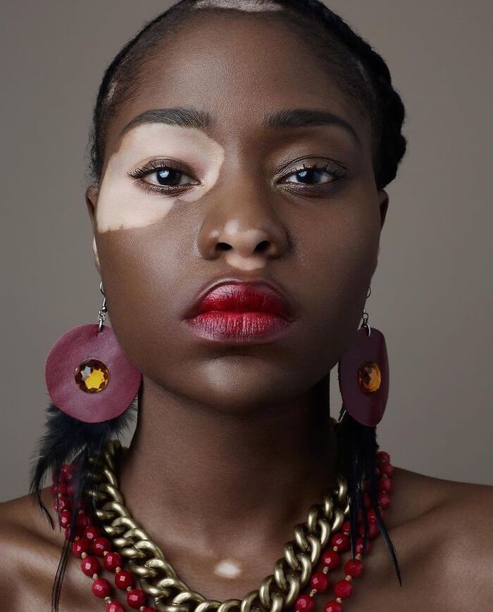 Vitiligo e autoestima: Perfil no Instagram transforma manchas em símbolo de beleza e identidade (30 fotos) 10 Vitiligo e autoestima: Perfil no Instagram transforma manchas em símbolo de beleza e identidade (30 fotos) 10