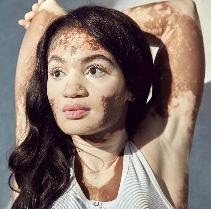 Vitiligo e autoestima: Perfil no Instagram transforma manchas em símbolo de beleza e identidade (30 fotos) 11 Vitiligo e autoestima: Perfil no Instagram transforma manchas em símbolo de beleza e identidade (30 fotos) 11