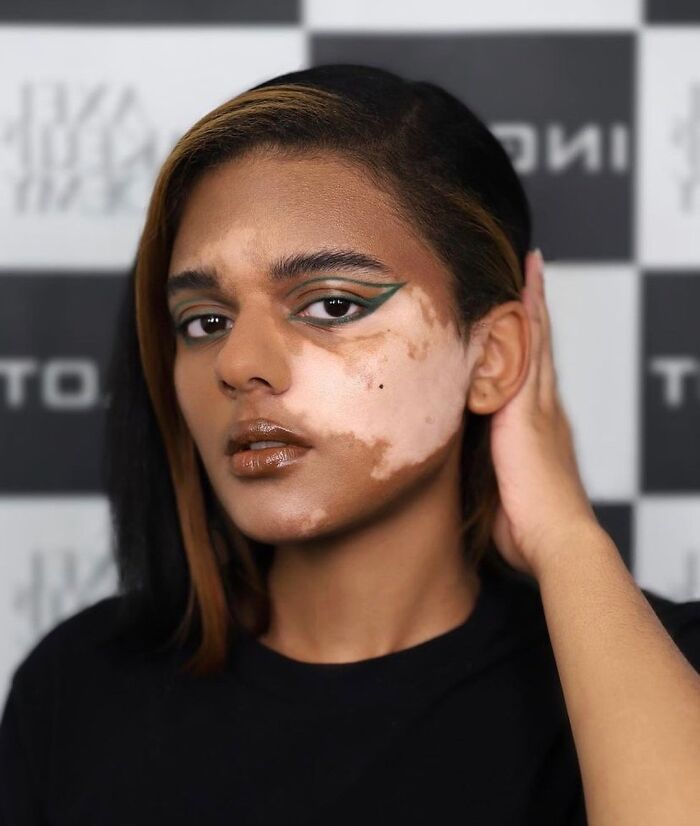 Vitiligo e autoestima: Perfil no Instagram transforma manchas em símbolo de beleza e identidade (30 fotos) 12 Vitiligo e autoestima: Perfil no Instagram transforma manchas em símbolo de beleza e identidade (30 fotos) 12