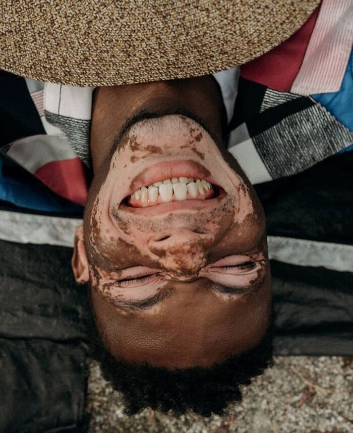 Vitiligo e autoestima: Perfil no Instagram transforma manchas em símbolo de beleza e identidade (30 fotos) 14 Vitiligo e autoestima: Perfil no Instagram transforma manchas em símbolo de beleza e identidade (30 fotos) 14