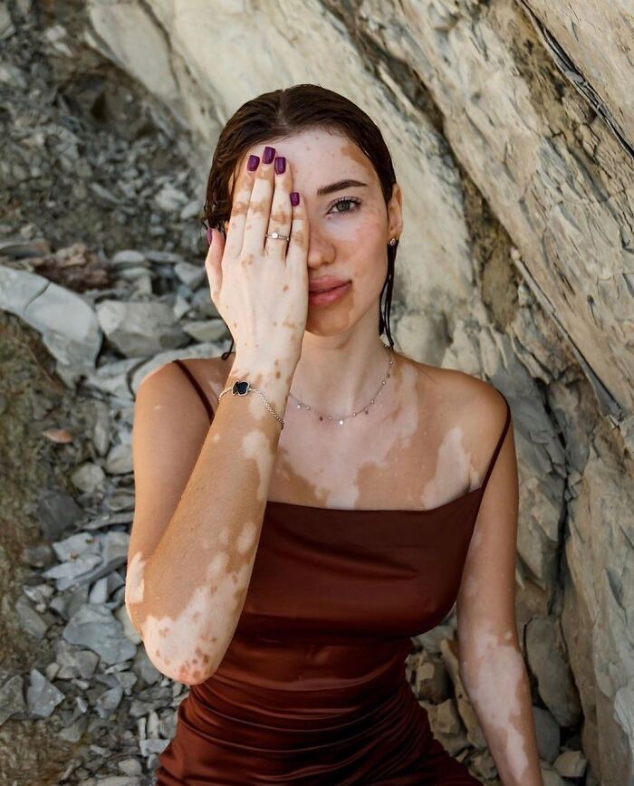 Vitiligo e autoestima: Perfil no Instagram transforma manchas em símbolo de beleza e identidade (30 fotos) 17 Vitiligo e autoestima: Perfil no Instagram transforma manchas em símbolo de beleza e identidade (30 fotos) 17