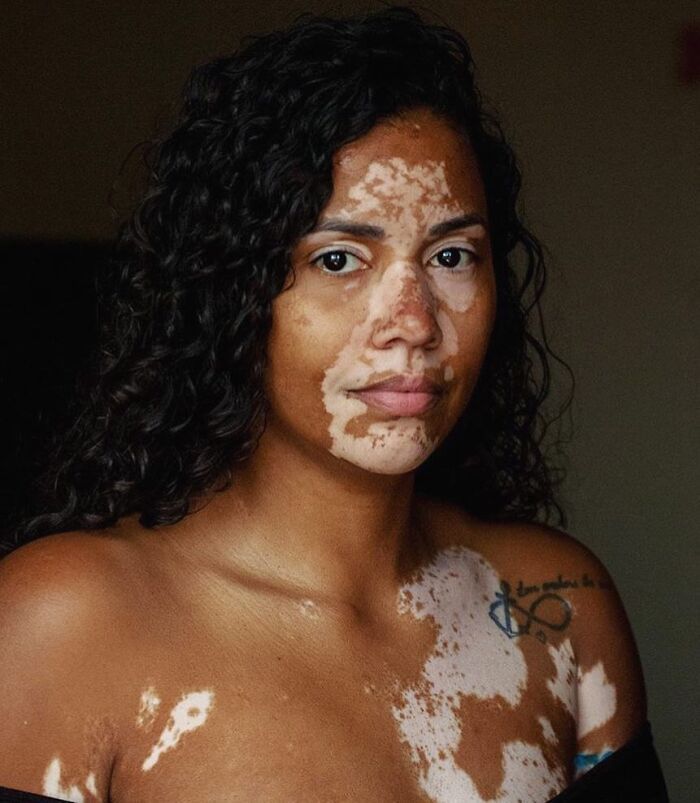 Vitiligo e autoestima: Perfil no Instagram transforma manchas em símbolo de beleza e identidade (30 fotos) 18 Vitiligo e autoestima: Perfil no Instagram transforma manchas em símbolo de beleza e identidade (30 fotos) 18