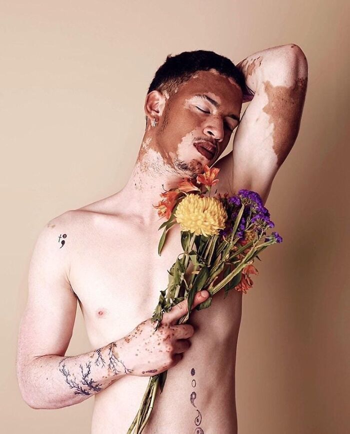 Vitiligo e autoestima: Perfil no Instagram transforma manchas em símbolo de beleza e identidade (30 fotos) 20 Vitiligo e autoestima: Perfil no Instagram transforma manchas em símbolo de beleza e identidade (30 fotos) 20