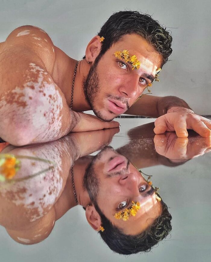 Vitiligo e autoestima: Perfil no Instagram transforma manchas em símbolo de beleza e identidade (30 fotos) 22 Vitiligo e autoestima: Perfil no Instagram transforma manchas em símbolo de beleza e identidade (30 fotos) 22