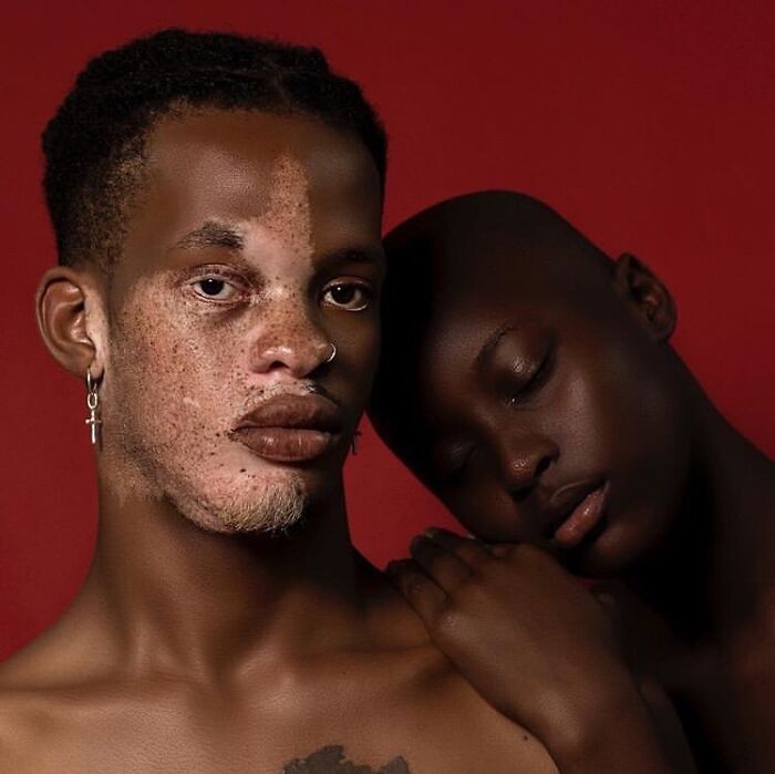 Vitiligo e autoestima: Perfil no Instagram transforma manchas em símbolo de beleza e identidade (30 fotos) 24 Vitiligo e autoestima: Perfil no Instagram transforma manchas em símbolo de beleza e identidade (30 fotos) 24