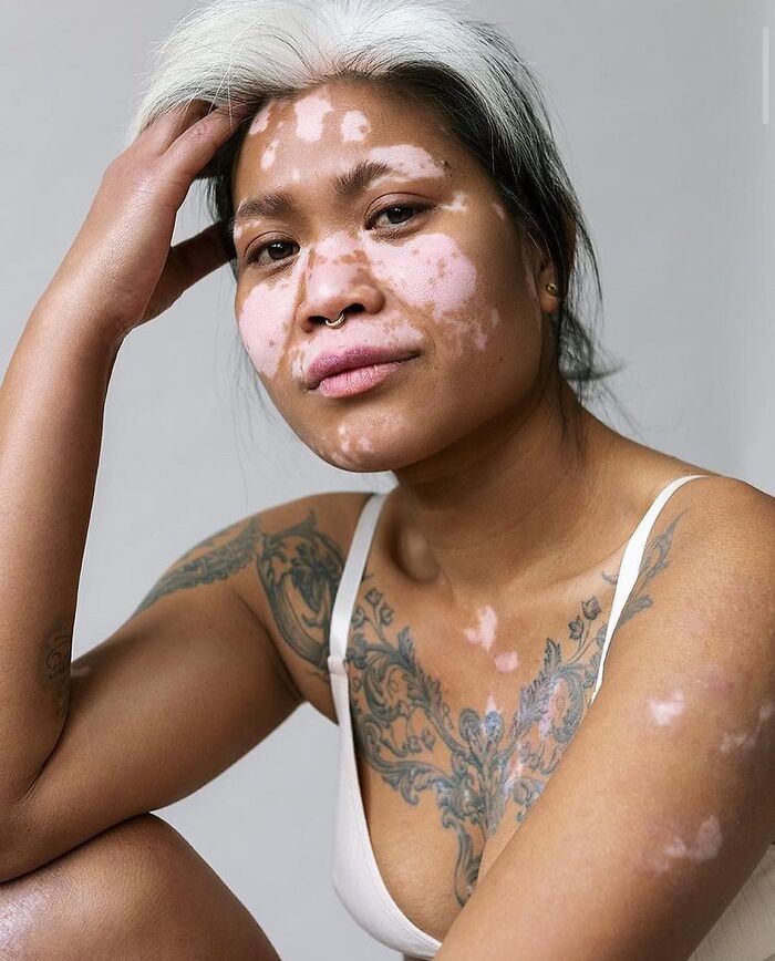 Vitiligo e autoestima: Perfil no Instagram transforma manchas em símbolo de beleza e identidade (30 fotos) 26 Vitiligo e autoestima: Perfil no Instagram transforma manchas em símbolo de beleza e identidade (30 fotos) 26