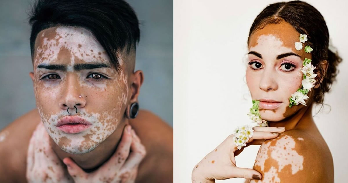 Vitiligo e autoestima: Perfil no Instagram transforma manchas em símbolo de beleza e identidade (30 fotos)